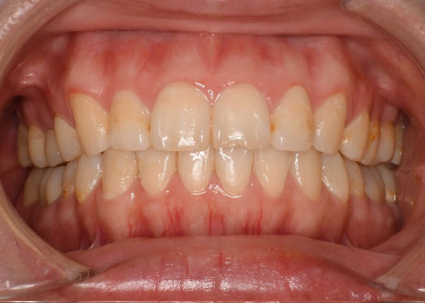 マウスピース矯正