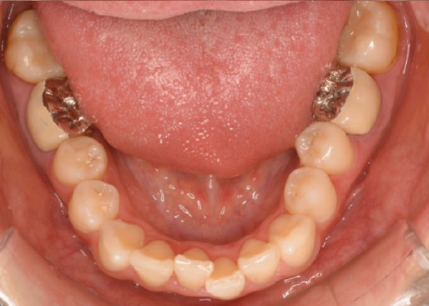 マウスピース矯正