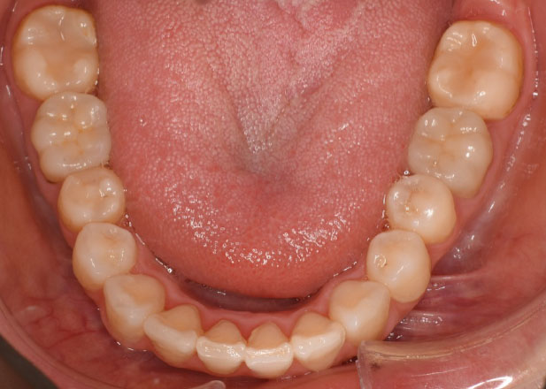 マウスピース矯正