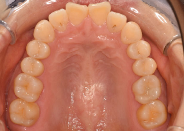 マウスピース矯正