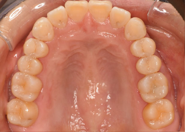 マウスピース矯正