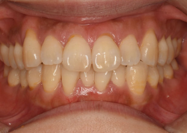 マウスピース矯正