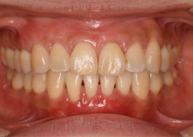 マウスピース矯正