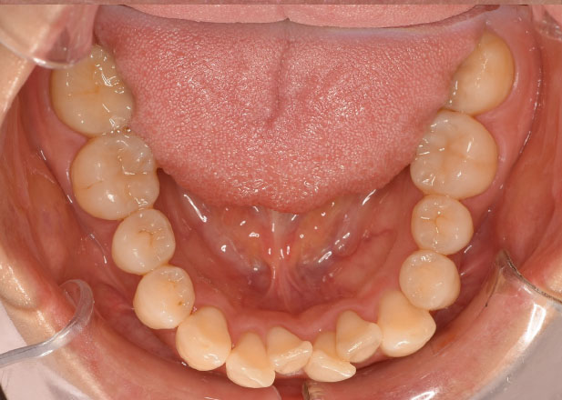 マウスピース矯正