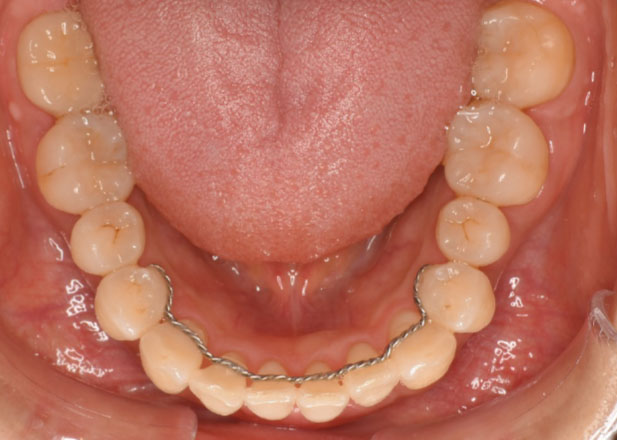 マウスピース矯正