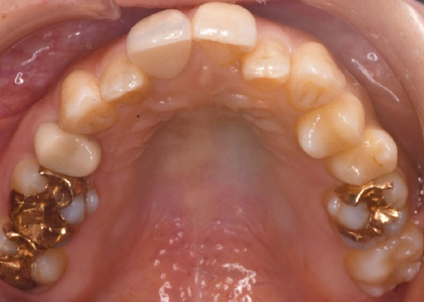 マウスピース矯正