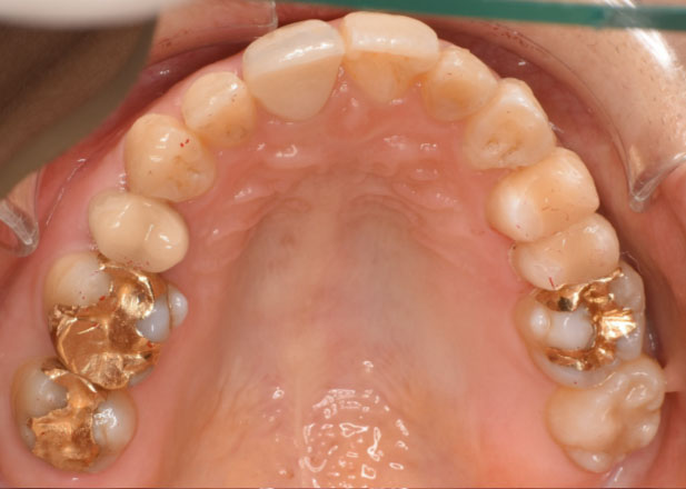 マウスピース矯正