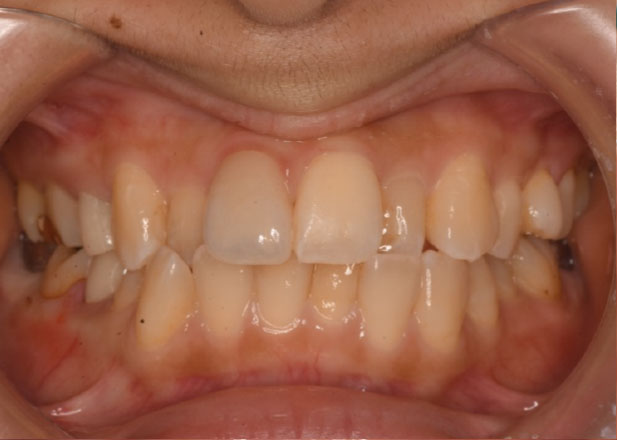 マウスピース矯正