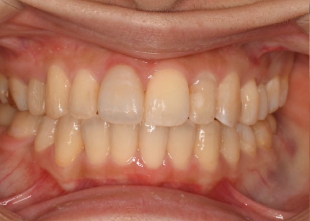 マウスピース矯正