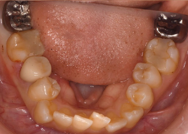 マウスピース矯正