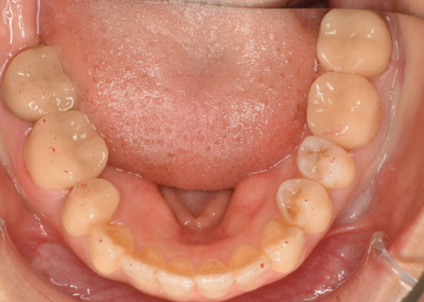 マウスピース矯正