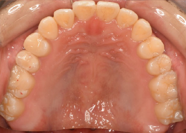 マウスピース矯正