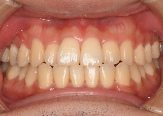 マウスピース矯正