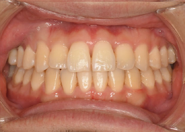 マウスピース矯正