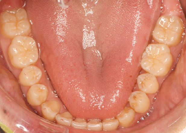 マウスピース矯正